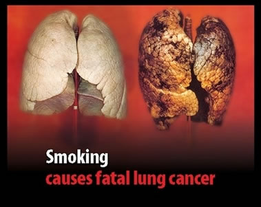 Cigarette Pack Warning Graphic